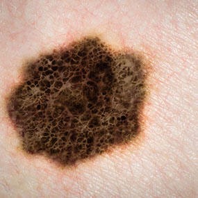 Getting a melanoma removed